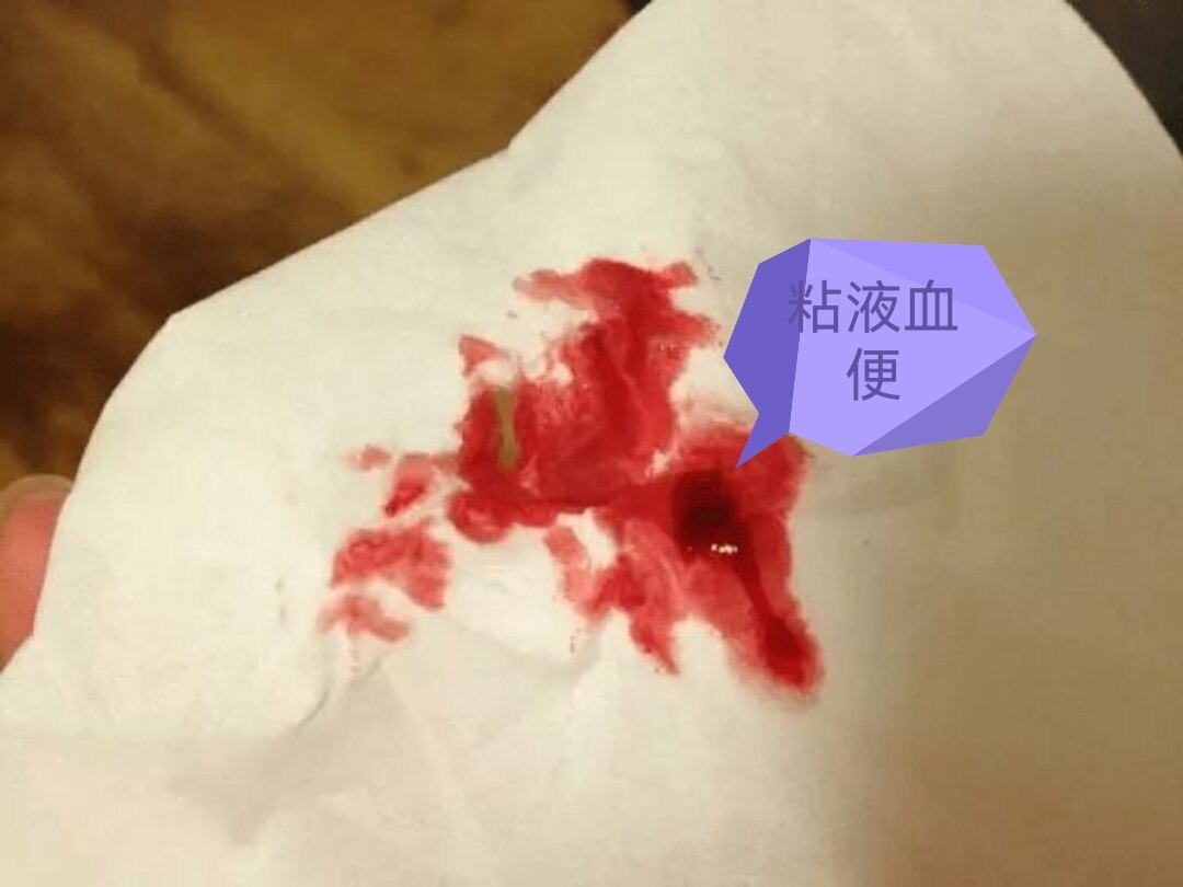 补硒会引起便血吗(吃补硒会导致大便发黑吗)-硒宝网