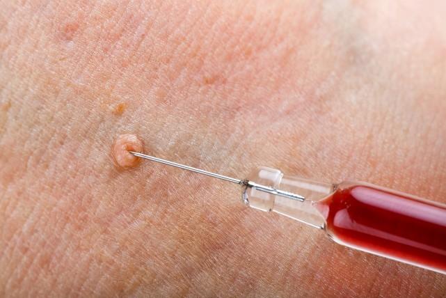 补硒对尖锐有用么（补硒可以治疗hpv吗）-硒宝网