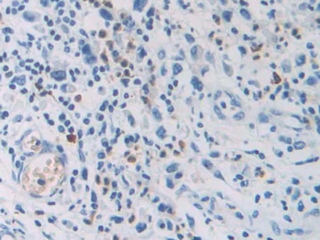 癌症补硒的进口药（癌症补硒）-硒宝网