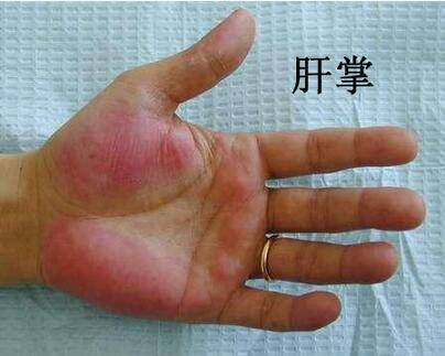 有肝硬化怎么补硒(肝硬化补硒有没有效果)-硒宝网