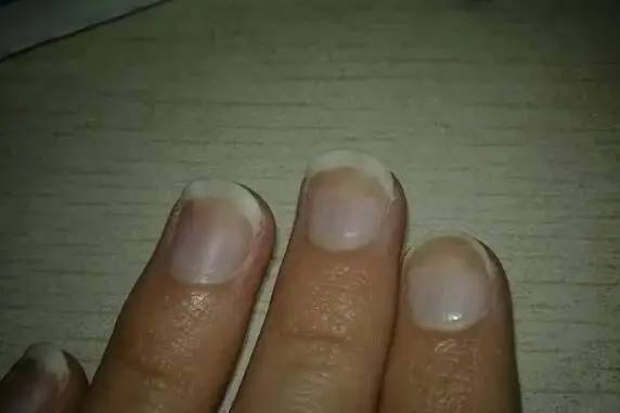 肝脏不好要补硒吗（补硒对肝病患者有好处吗）-硒宝网