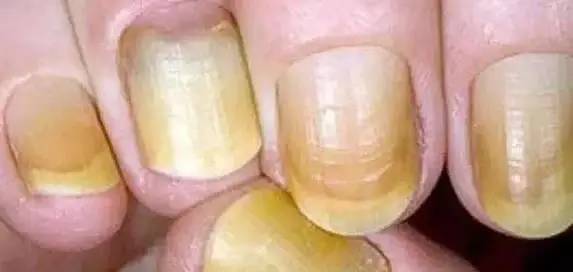 肝脏不好要补硒吗（补硒对肝病患者有好处吗）-硒宝网