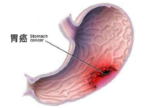 补硒能缓解胃痛吗（补硒对胃有什么好处）-硒宝网