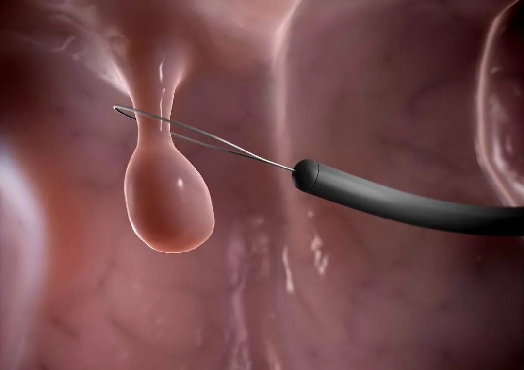 补硒对肠息肉好处（切除了肠息肉能吃硒元素吗）-硒宝网