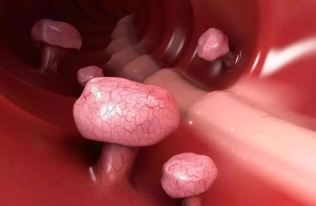 补硒对肠息肉好处（切除了肠息肉能吃硒元素吗）-硒宝网