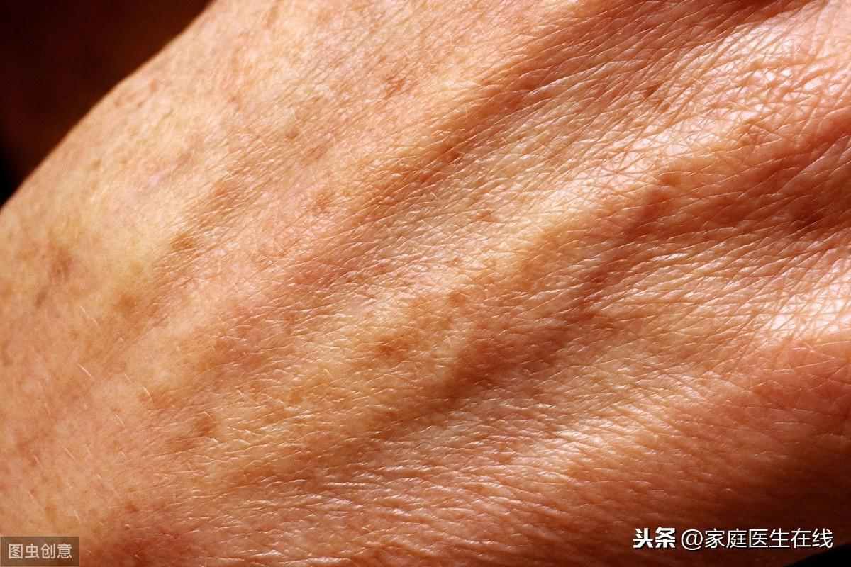 补硒能去老年斑吗（补硒能淡化色斑吗）-硒宝网