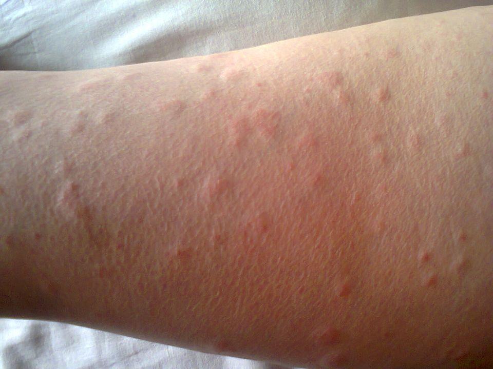 荨麻疹有必要补硒(荨麻疹吃硒酵母有用吗)-硒宝网