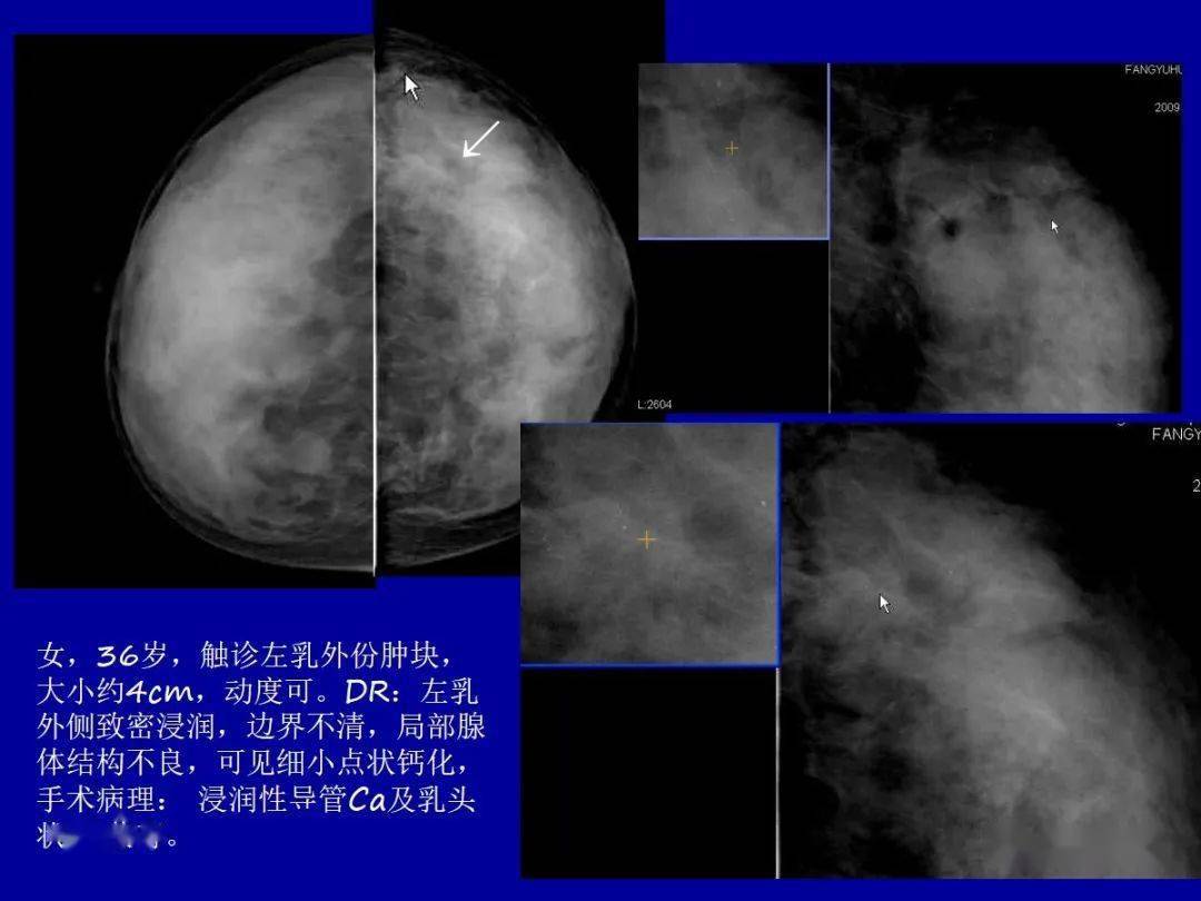 乳腺癌补什么硒好(乳腺癌补硒一天用量是多少)-硒宝网