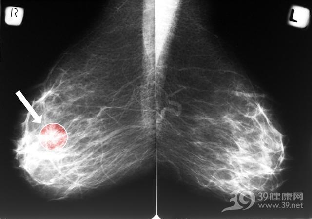 乳腺癌补什么硒好(乳腺癌补硒一天用量是多少)-硒宝网