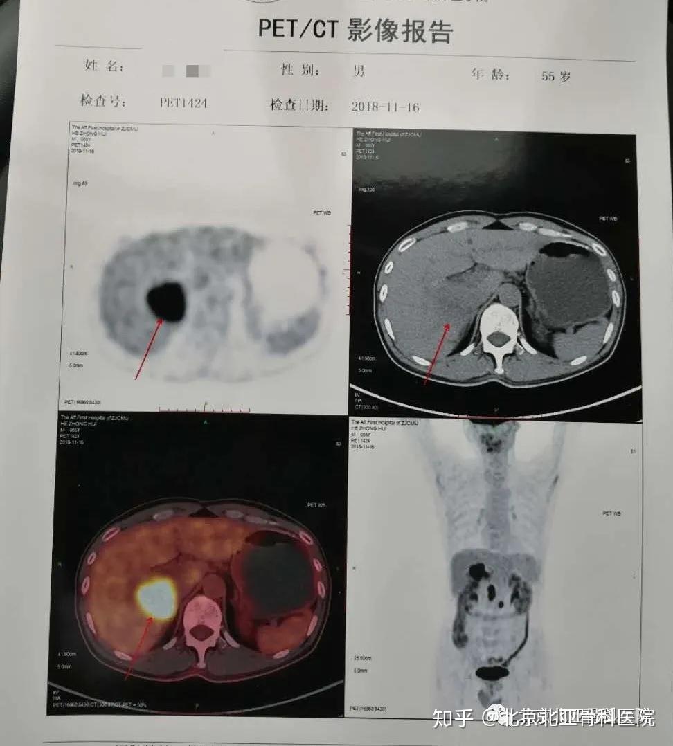 肝癌病人能补硒吗(病人能补肝癌硒元素吗)-硒宝网