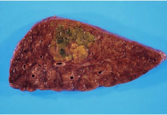 脂肪肝补硒管用吗(脂肪肝要补锌吗)-硒宝网