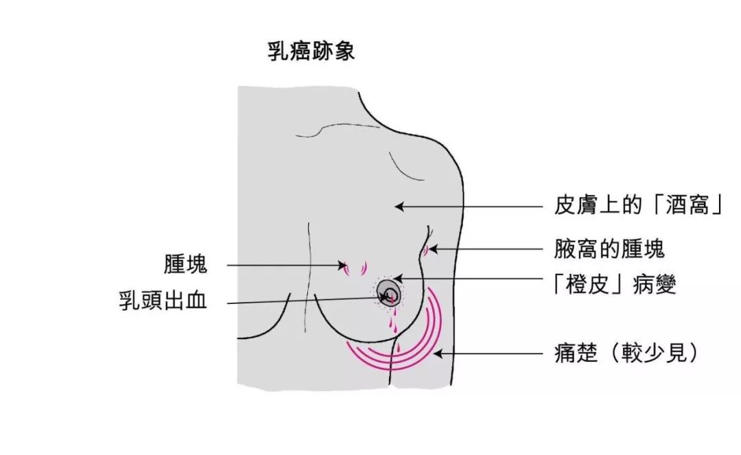 乳腺癌补硒的水果(补硒对乳腺癌有什么好处)-硒宝网