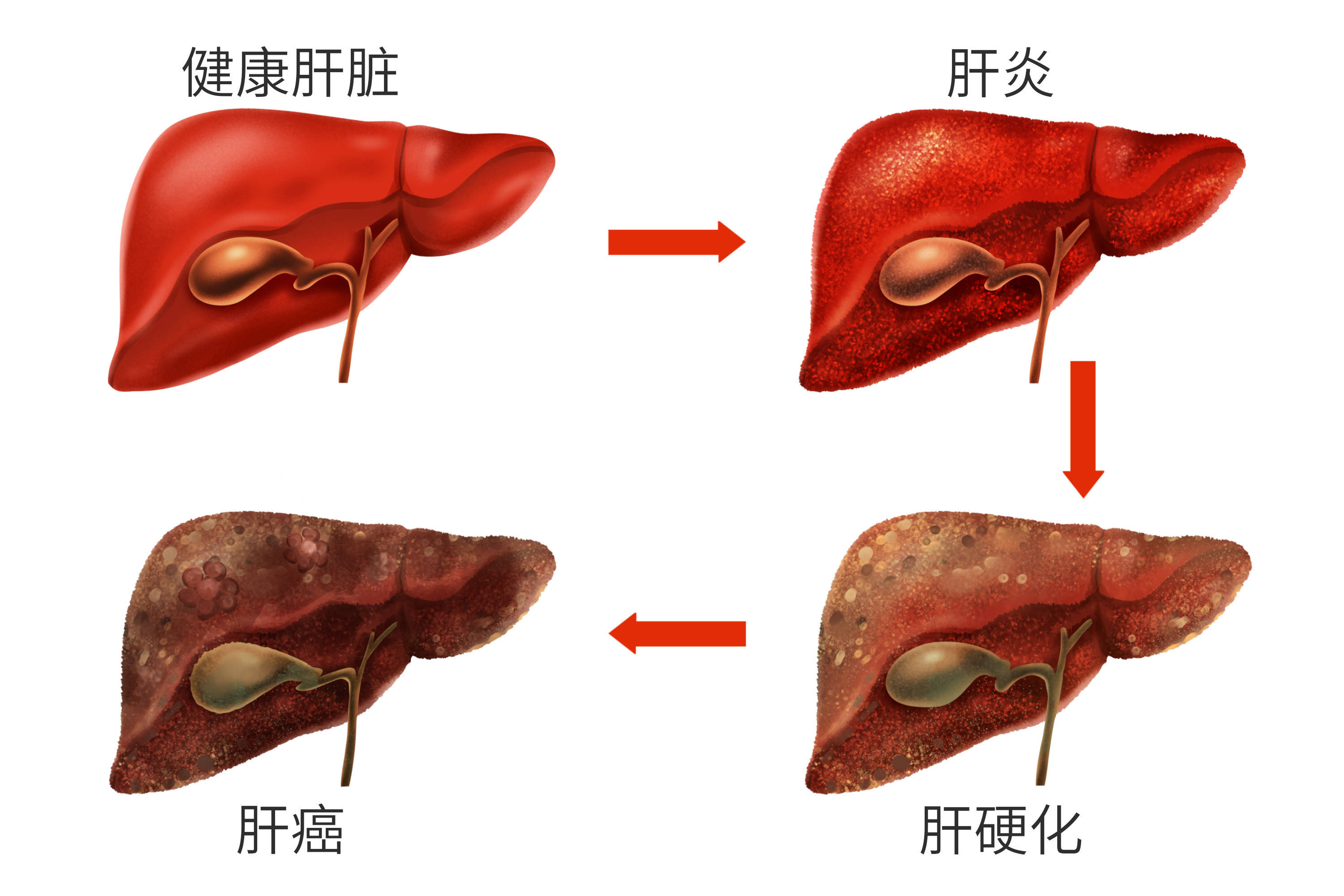 脂肪肝为什么补硒（硒片对脂肪肝有作用吗）-硒宝网