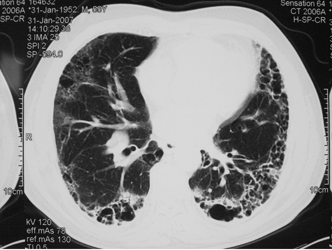 肺纤维化用补硒吗(肺纤维补化硒用什么药)-硒宝网