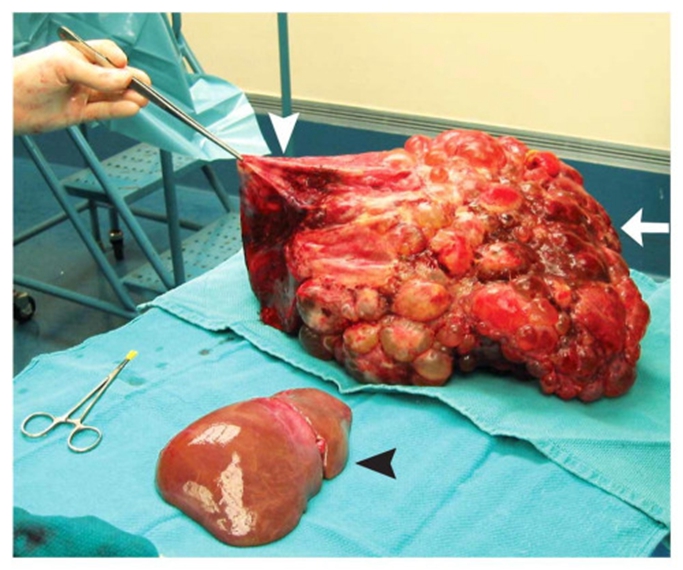 肺纤维化用补硒吗(肺纤维补化硒用什么药)-硒宝网