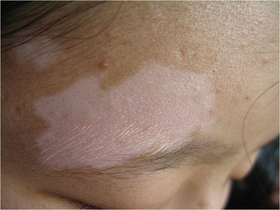 白癜风能不能补硒（新硒望科学补硒协会）-硒宝网