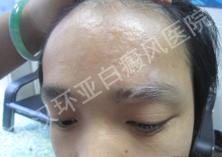 白癜风能不能补硒（新硒望科学补硒协会）-硒宝网