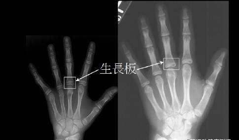 补硒有助于长高吗（补硒增强免疫力）-硒宝网