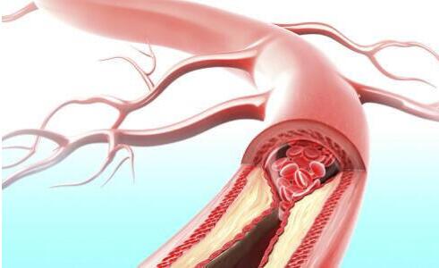 补硒能治新脑血管(硒对脑血管的功效)-硒宝网