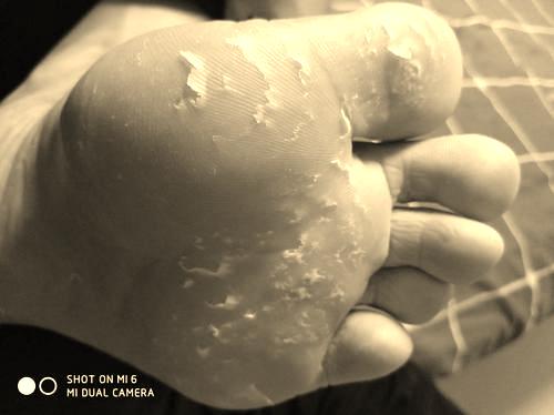 手脱皮补硒有用吗（补硒一般要连续补多久）-硒宝网