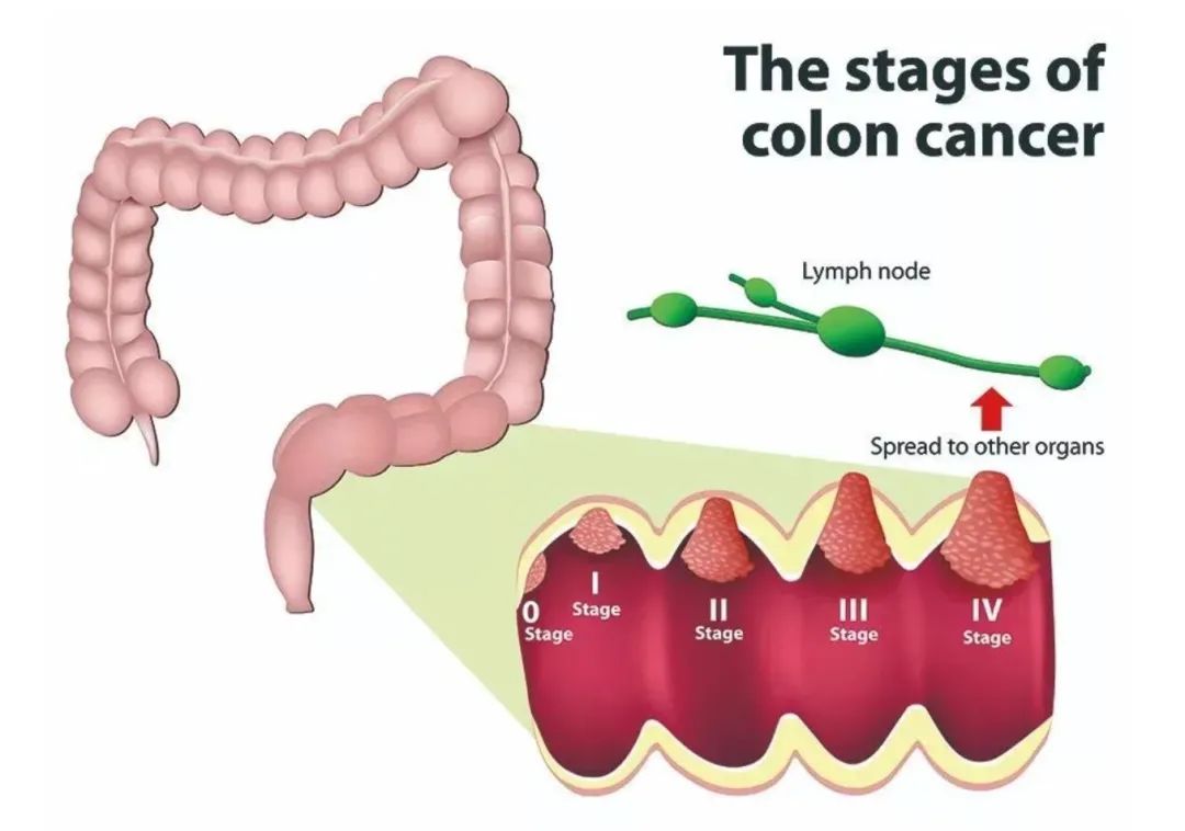 结肠癌是哪种补硒(结肠癌吃硒好吗)-硒宝网