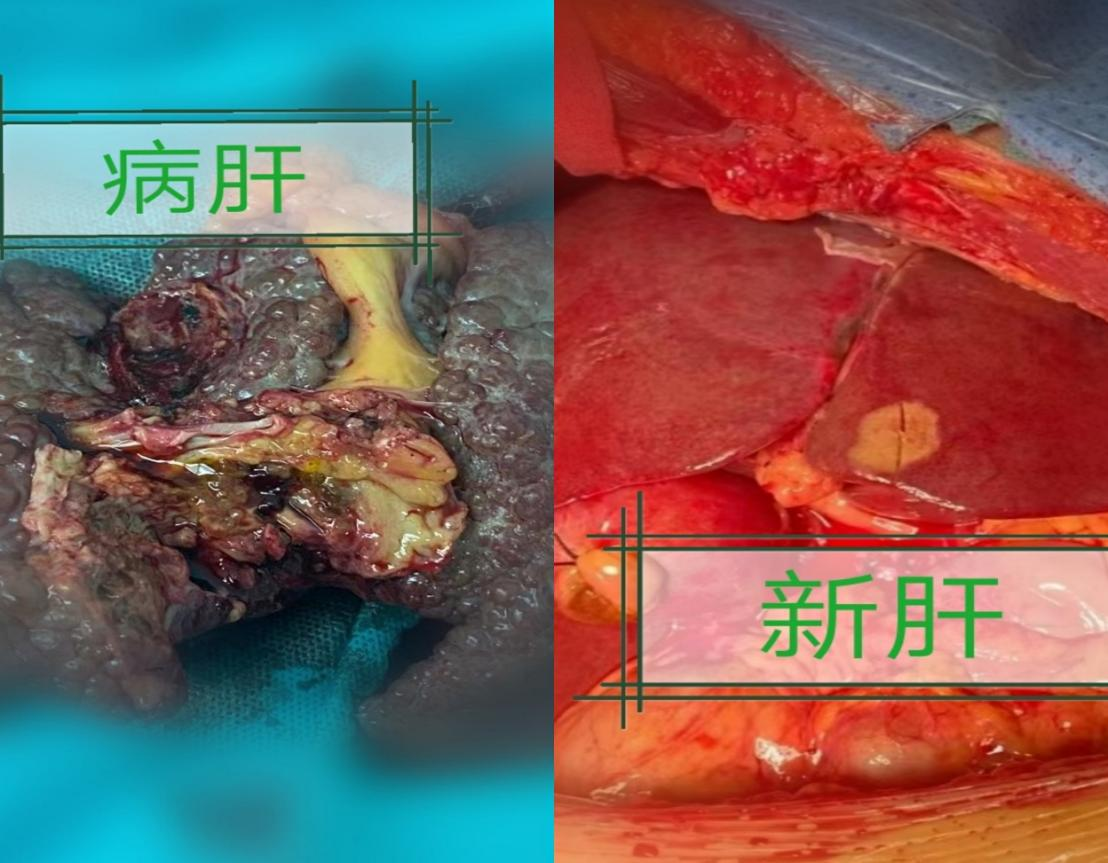 肝病患者补多少硒（补患者肝病硒片能吃吗）-硒宝网