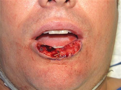 补硒 对前列腺癌(前列补硒腺癌能治好吗)-硒宝网