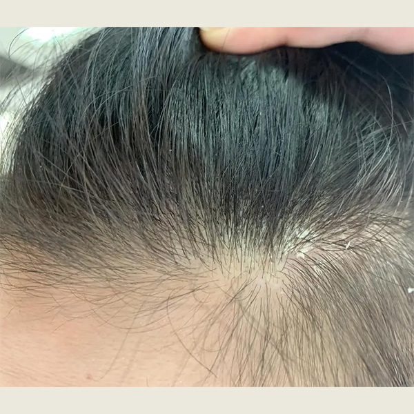 头皮屑多需要补硒(补头皮屑需要硒含量多少)-硒宝网