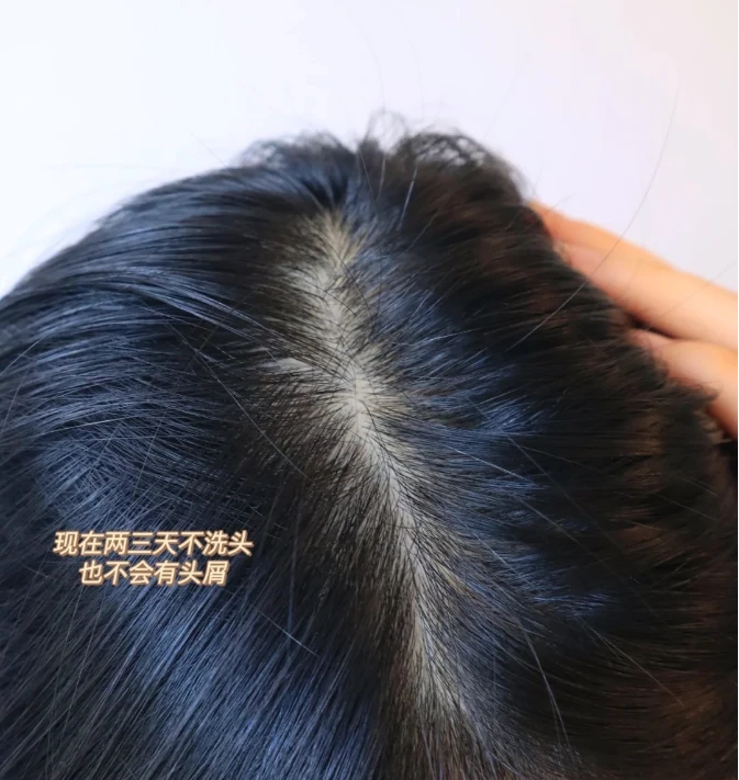 头皮屑多需要补硒(补头皮屑需要硒含量多少)-硒宝网