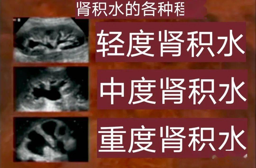 尿毒症补硒的研究(硒对尿毒症有用吗)-硒宝网