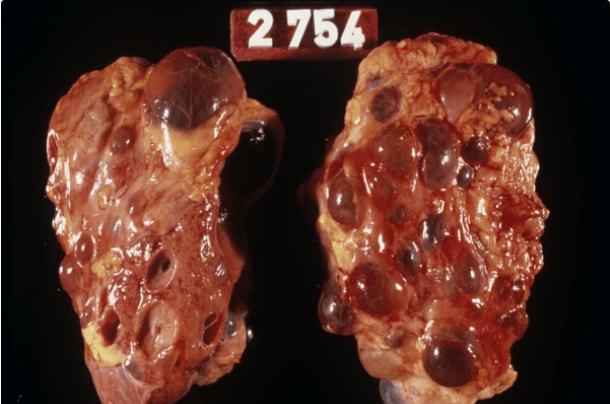 尿毒症补硒的研究(硒对尿毒症有用吗)-硒宝网