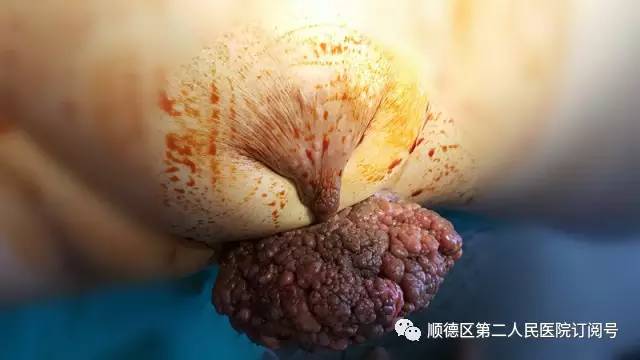 补硒能预防乳腺炎(补硒可以治疗乳腺纤维瘤吗)-硒宝网