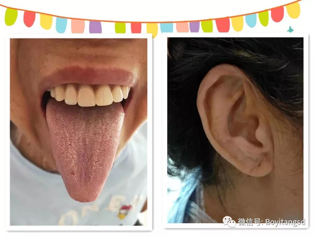 丝状疣补硒有用吗(丝状疣吃硒片有用吗)-硒宝网