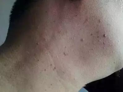 丝状疣补硒有用吗(丝状疣吃硒片有用吗)-硒宝网