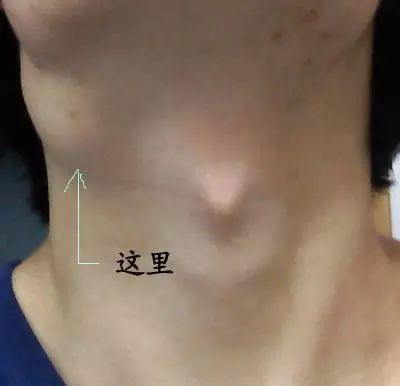 丝状疣补硒有用吗(丝状疣吃硒片有用吗)-硒宝网