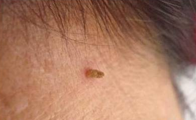 丝状疣补硒有用吗(补疣丝状硒用有副作用吗)-硒宝网