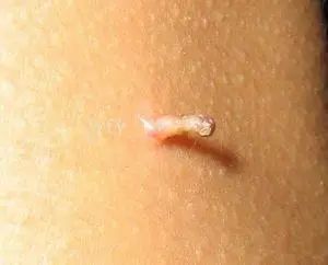 丝状疣补硒有用吗(补疣丝状硒用有副作用吗)-硒宝网