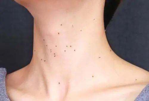 丝状疣补硒有用吗(补疣丝状硒用有效果吗)-硒宝网