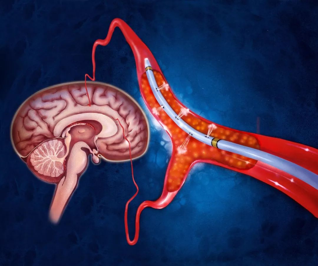 脑梗塞补硒可以吗（补硒对脑梗有哪些作用）-硒宝网