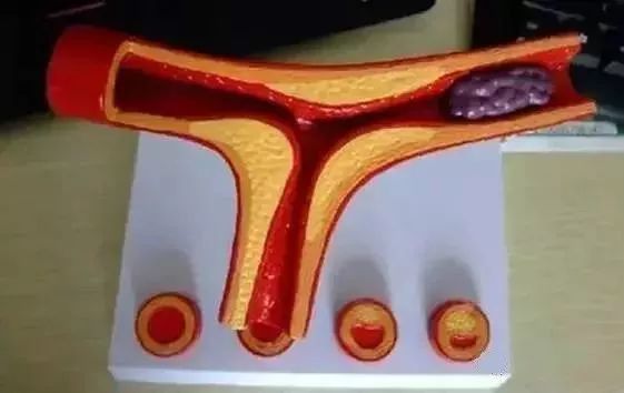 脑梗塞补硒可以吗(硒与脑梗塞)-硒宝网