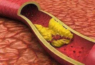 脑梗塞补硒可以吗(硒与脑梗塞)-硒宝网