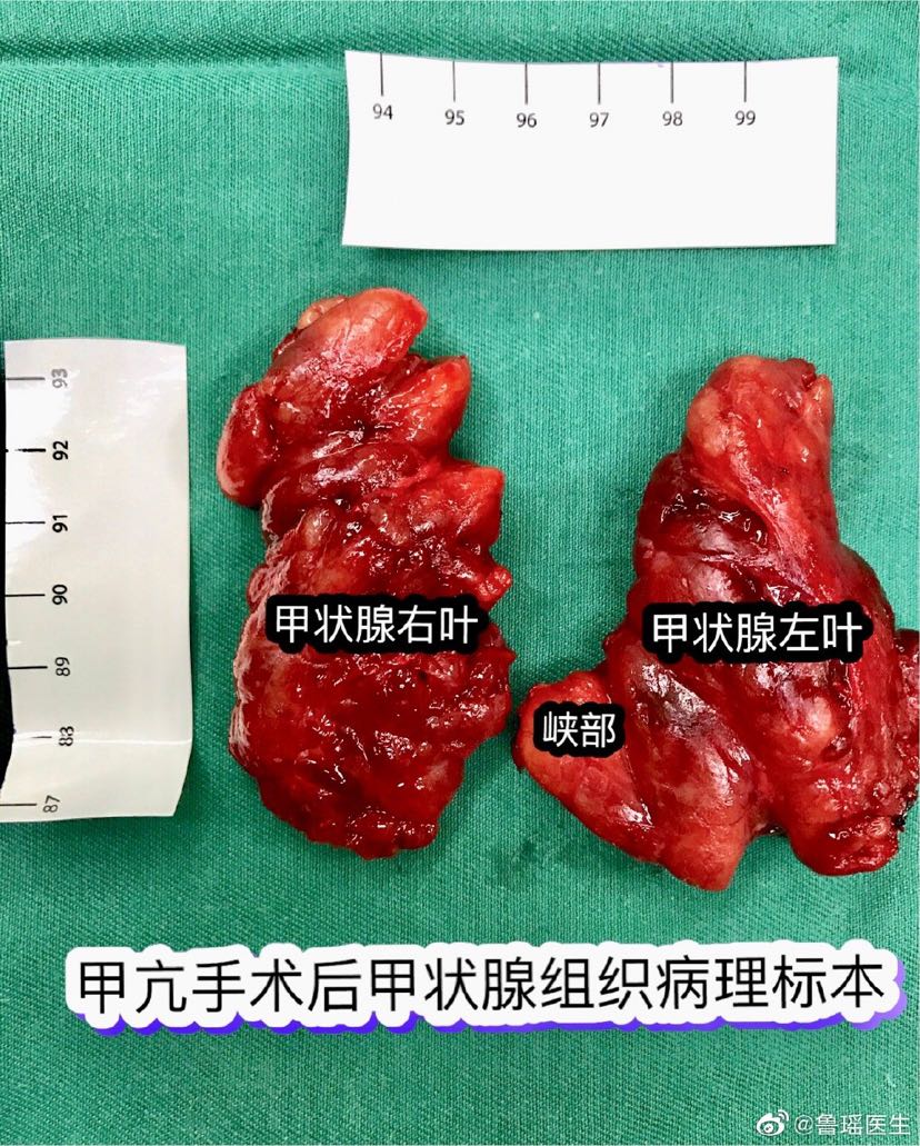 甲癌术后能补硒吗(甲状腺癌手术后能补硒)-硒宝网