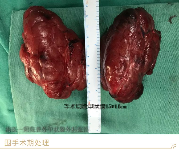 甲癌术后能补硒吗(甲状腺癌手术后能补硒)-硒宝网