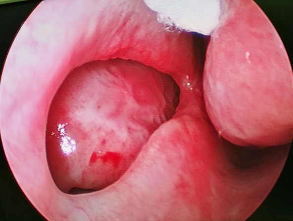 甲癌术后能补硒吗(甲状腺癌手术后能补硒)-硒宝网