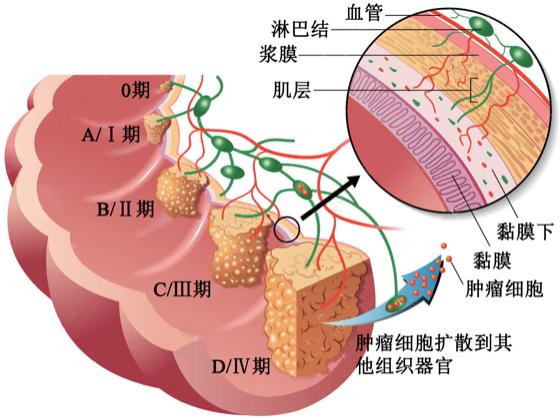 直肠癌可以补硒吗(补硒对肠癌有帮助吗)-硒宝网