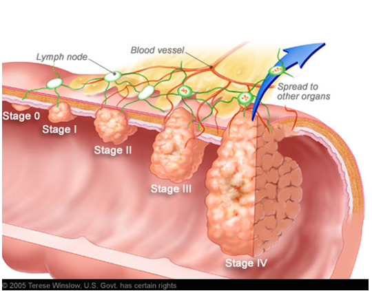 直肠癌可以补硒吗(补硒对肠癌有帮助吗)-硒宝网