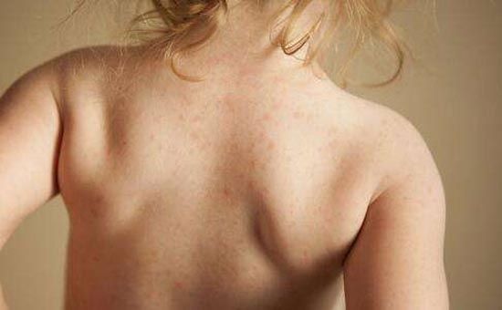 荨麻疹补硒有用吗(补荨麻疹硒用有效果吗)-硒宝网