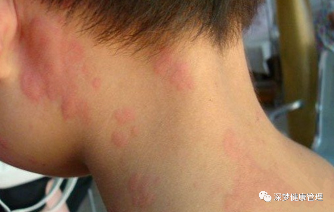 荨麻疹补硒有用吗(补荨麻疹硒用有副作用吗)-硒宝网