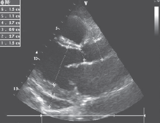 扩张型心肌病补硒（扩张型心肌病新药）-硒宝网