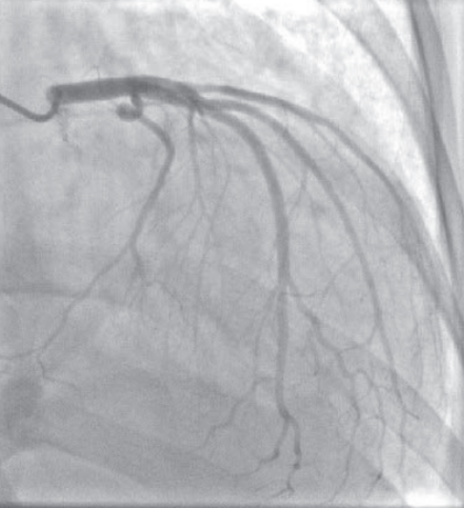 扩张型心肌病补硒（扩张型心肌病新药）-硒宝网